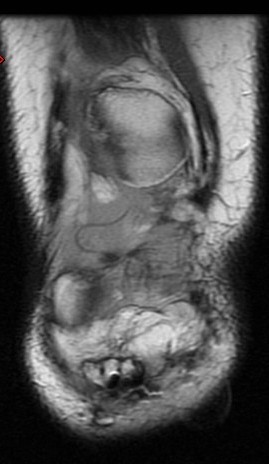 Figure 3 for case Patellar tendon re-tear